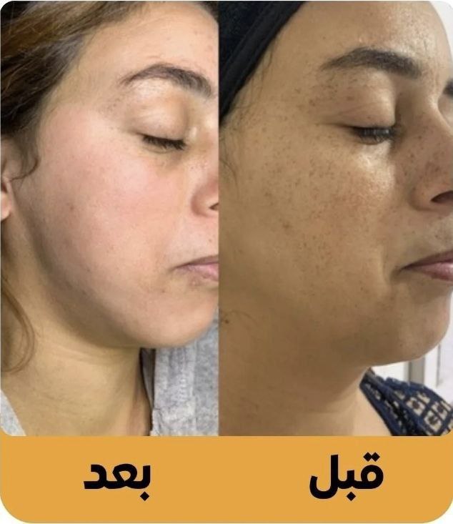 SNOW BLEACH كريم التبييض